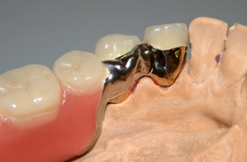 Riegelprothese auf dem Modell von der Zungenseite
