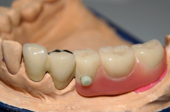 Riegelprothese auf dem Modell, der kleine Druckknopf ist zu sehen