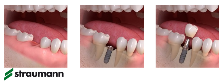 Drei Schritte: Zahnlücke, eingesetztes Implantat, Implantat mit Krone