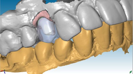 Konstruktion von Abutment und Krone am Bildschirm
